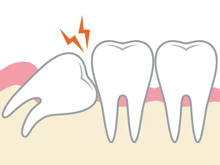 斜めに歯が生えたことによって痛みが出るイメージイラスト