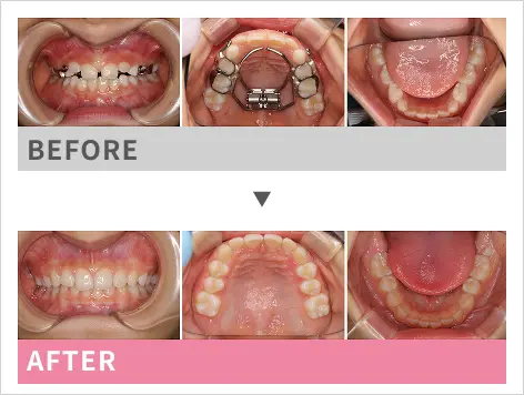 小児矯正歯科ケース１の口腔内比較画像
