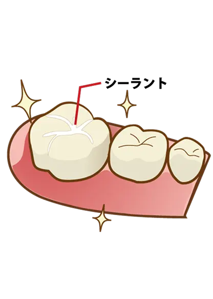 シーラントの説明イラスト