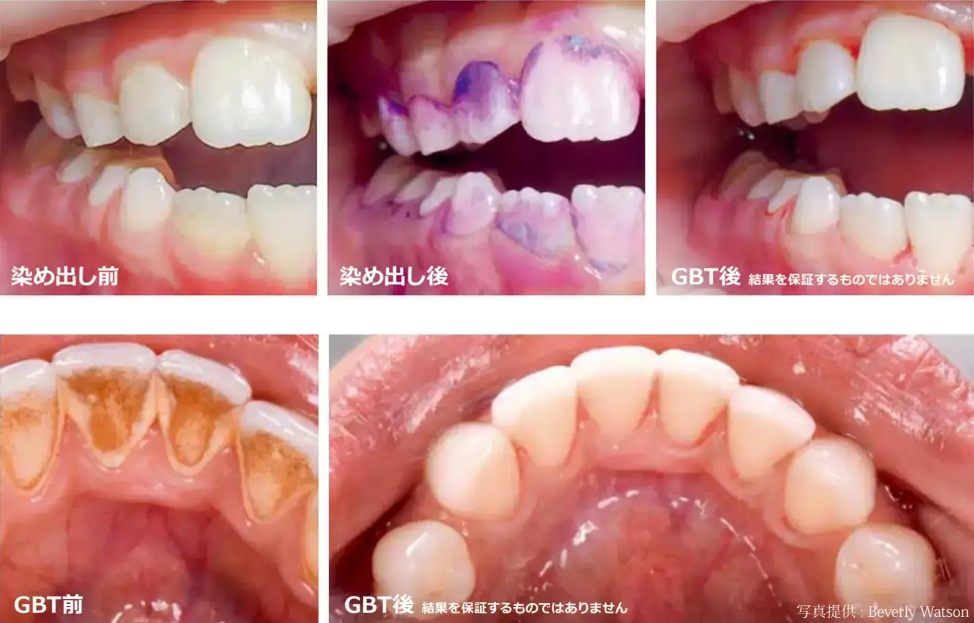 GBTでの処置の様子